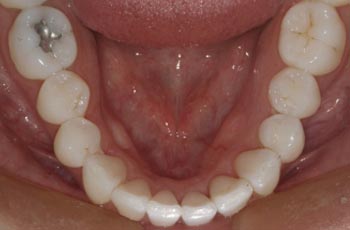 Invisalign Orthodontic Treatment After