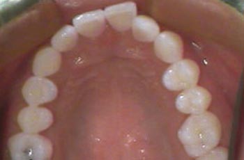 Invisalign Orthodontic Treatment Before